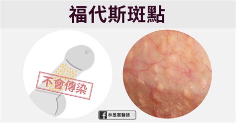 生殖器長一顆|包皮長一粒一粒東西？5 種「陰莖顆粒」可能成因解析，不一定是。